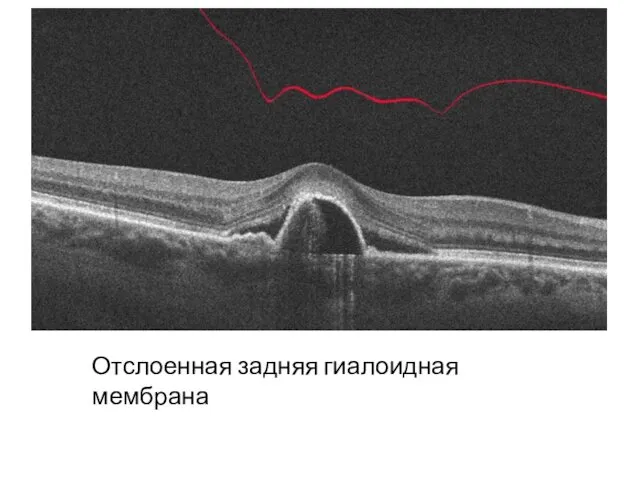 Отслоенная задняя гиалоидная мембрана