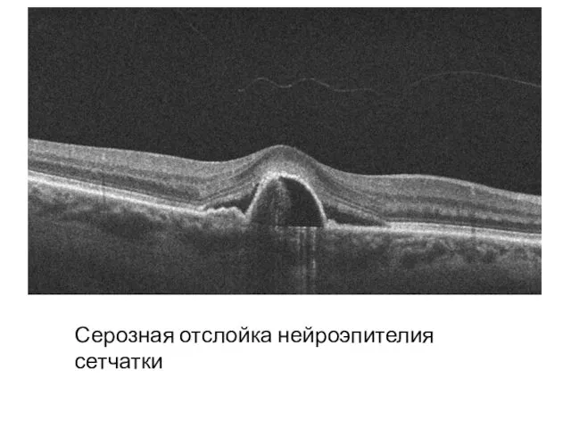 Серозная отслойка нейроэпителия сетчатки