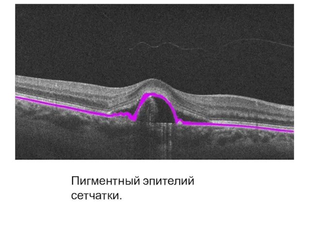 Пигментный эпителий сетчатки.