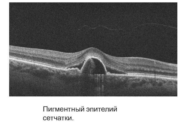 Пигментный эпителий сетчатки.