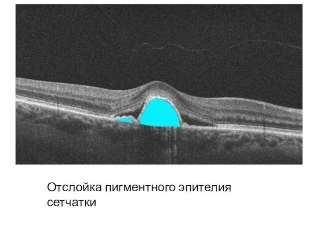 Отслойка пигментного эпителия сетчатки