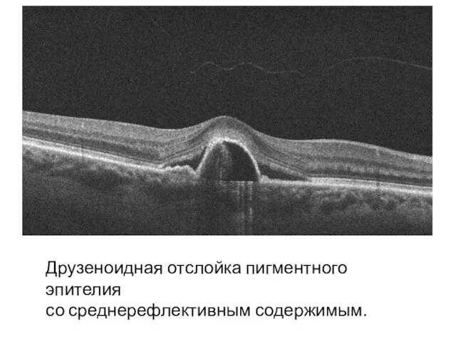 Друзеноидная отслойка пигментного эпителия со среднерефлективным содержимым.