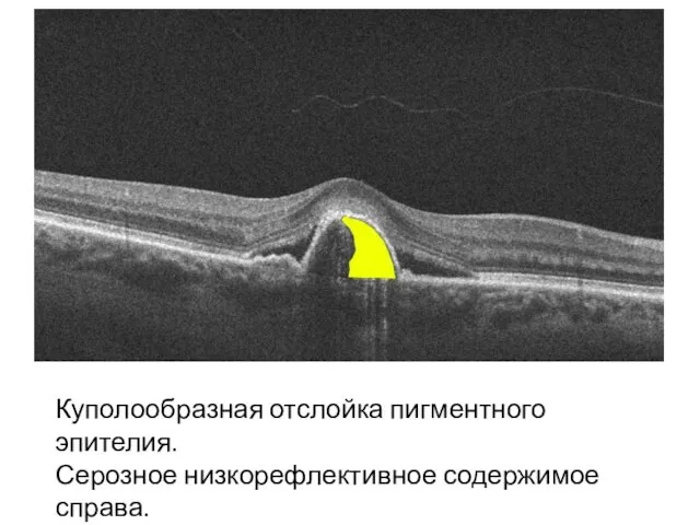 Куполообразная отслойка пигментного эпителия. Серозное низкорефлективное содержимое справа.