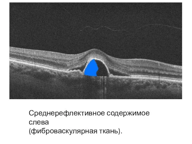 Среднерефлективное содержимое слева (фиброваскулярная ткань).