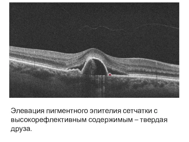 Элевация пигментного эпителия сетчатки с высокорефлективным содержимым – твердая друза.