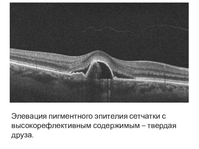 Элевация пигментного эпителия сетчатки с высокорефлективным содержимым – твердая друза.