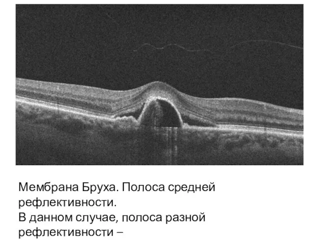 Мембрана Бруха. Полоса средней рефлективности. В данном случае, полоса разной рефлективности – от низкой до высокой.