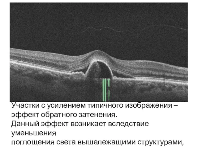 Участки с усилением типичного изображения – эффект обратного затенения. Данный эффект