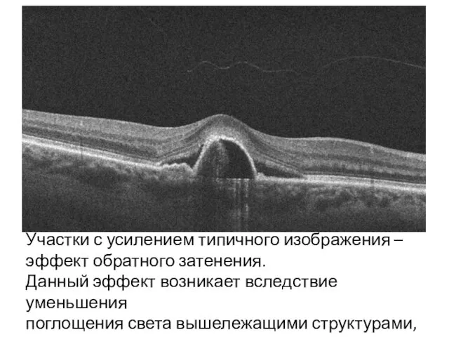 Участки с усилением типичного изображения – эффект обратного затенения. Данный эффект