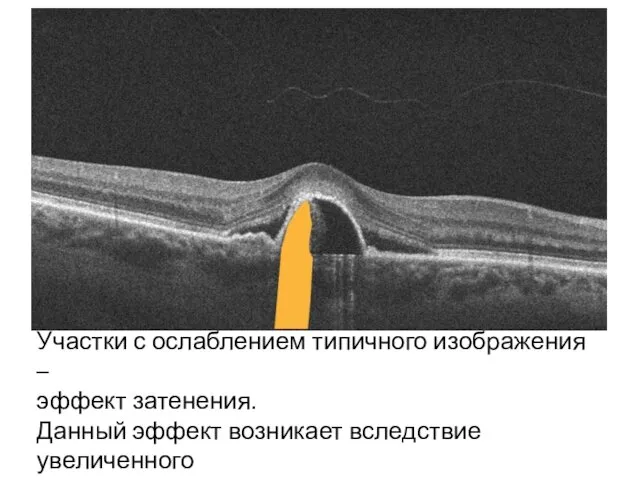 Участки с ослаблением типичного изображения – эффект затенения. Данный эффект возникает