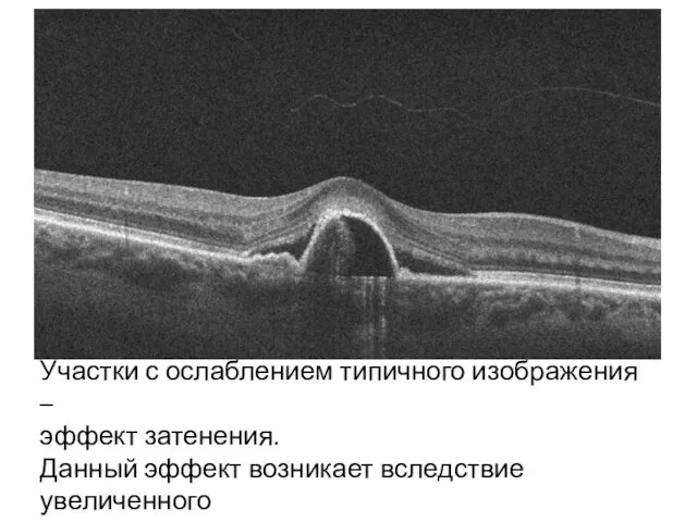 Участки с ослаблением типичного изображения – эффект затенения. Данный эффект возникает