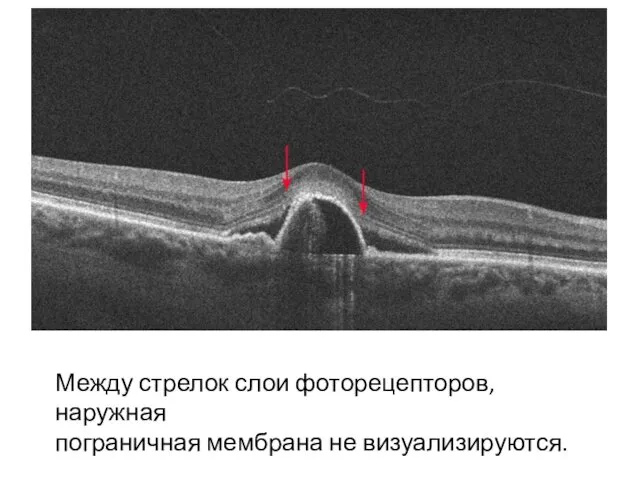 Между стрелок слои фоторецепторов, наружная пограничная мембрана не визуализируются.