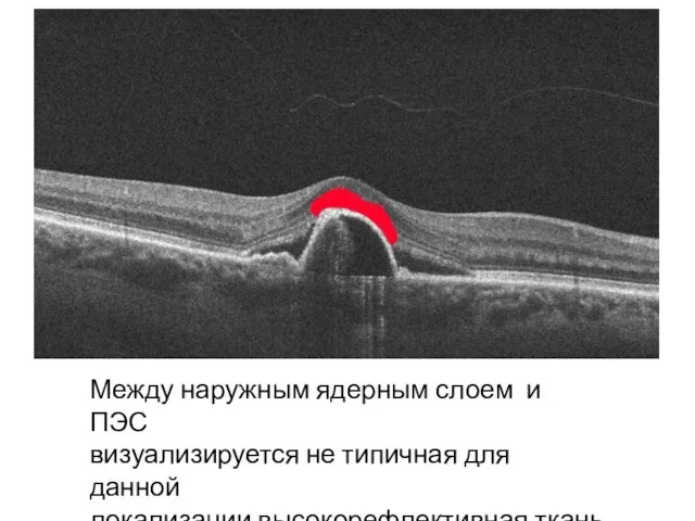 Между наружным ядерным слоем и ПЭС визуализируется не типичная для данной