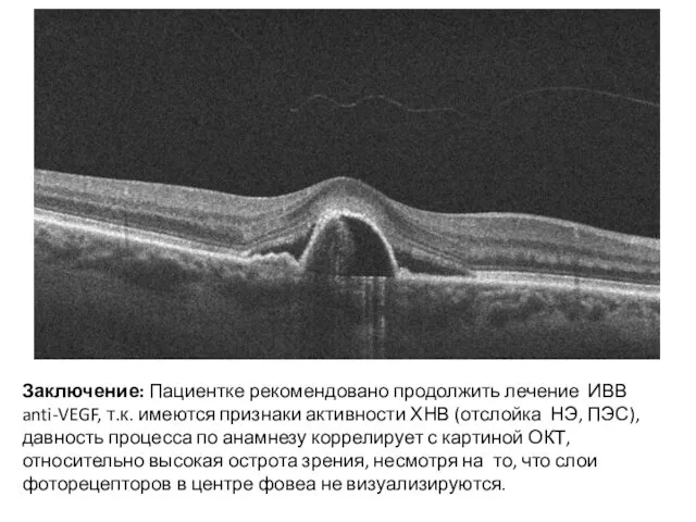 Заключение: Пациентке рекомендовано продолжить лечение ИВВ anti-VEGF, т.к. имеются признаки активности