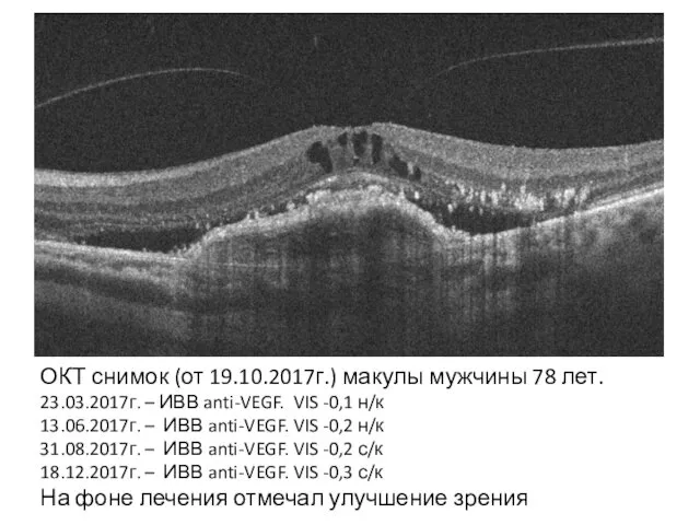 ОКТ снимок (от 19.10.2017г.) макулы мужчины 78 лет. 23.03.2017г. – ИВВ