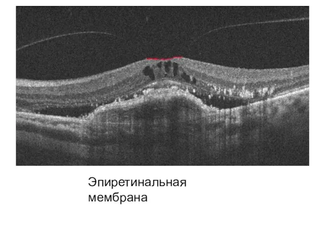 Эпиретинальная мембрана