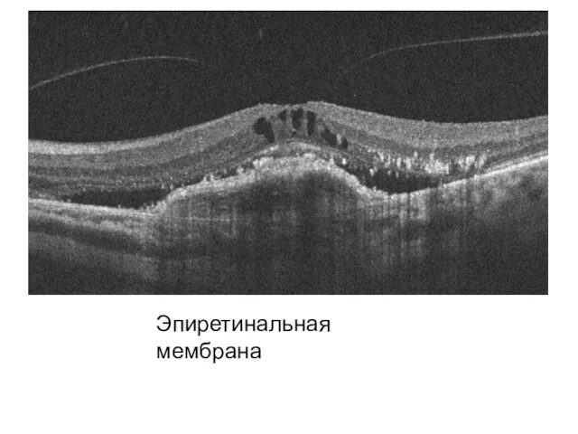 Эпиретинальная мембрана