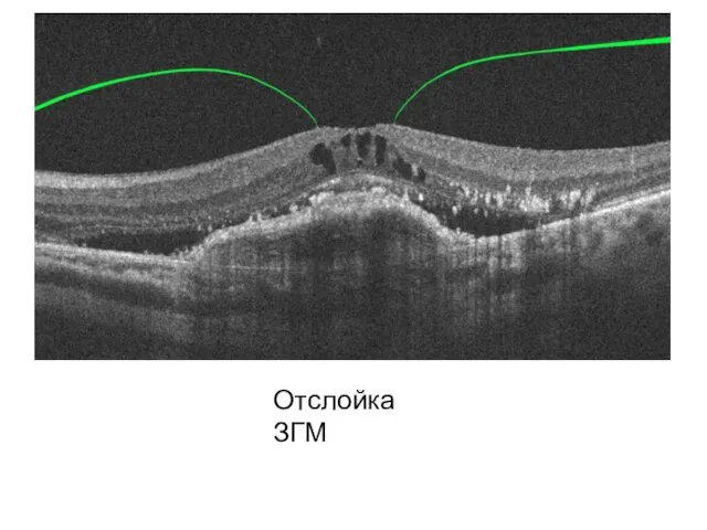Отслойка ЗГМ