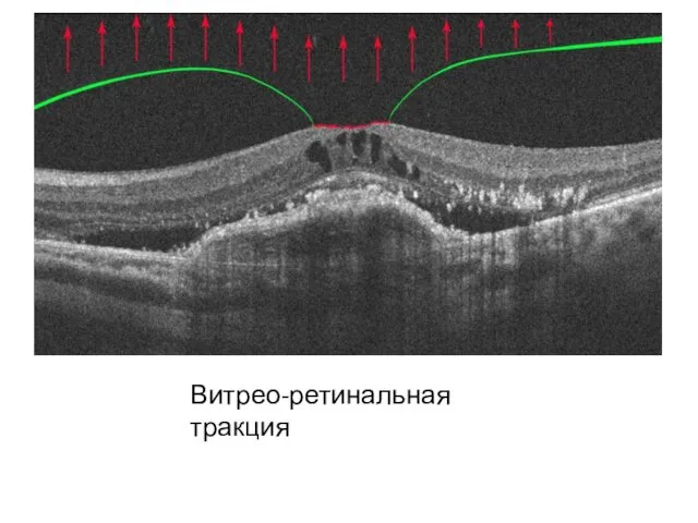 Витрео-ретинальная тракция