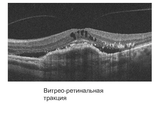 Витрео-ретинальная тракция