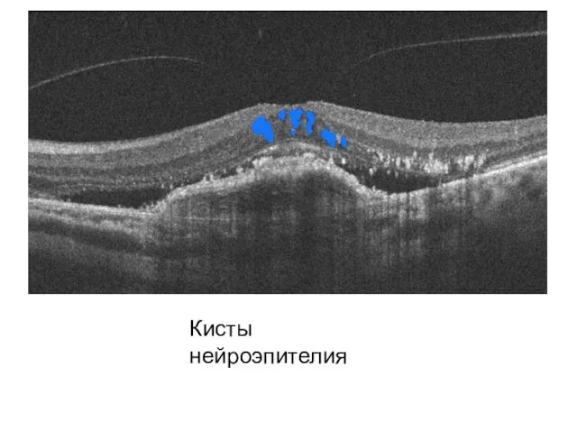 Кисты нейроэпителия