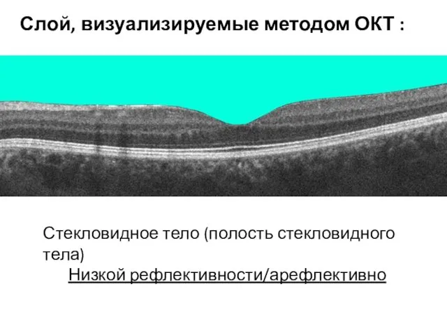 Стекловидное тело (полость стекловидного тела) Низкой рефлективности/арефлективно Слой, визуализируемые методом ОКТ :