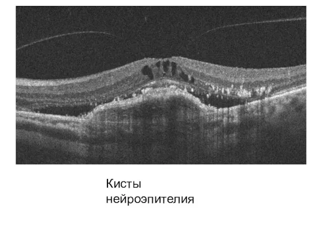 Кисты нейроэпителия