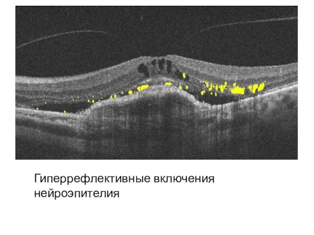 Гиперрефлективные включения нейроэпителия