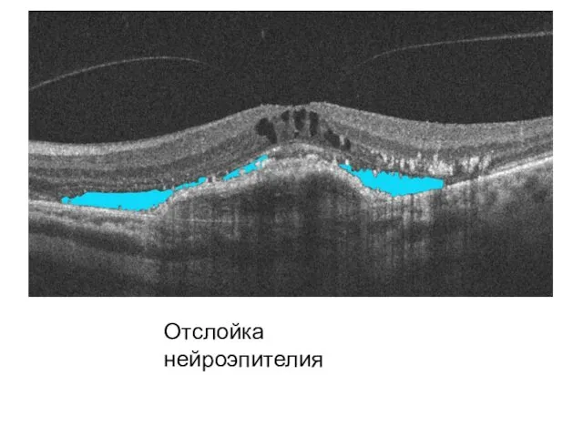 Отслойка нейроэпителия