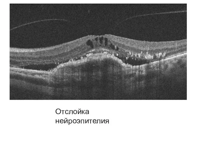 Отслойка нейроэпителия