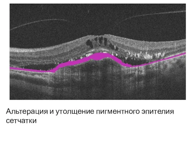 Альтерация и утолщение пигментного эпителия сетчатки