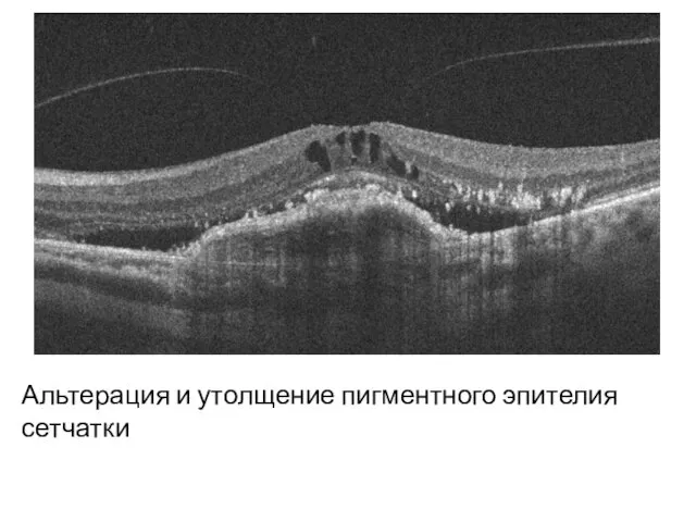 Альтерация и утолщение пигментного эпителия сетчатки