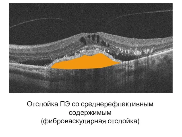 Отслойка ПЭ со среднерефлективным содержимым (фиброваскулярная отслойка)