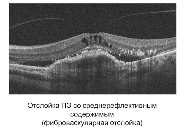 Отслойка ПЭ со среднерефлективным содержимым (фиброваскулярная отслойка)