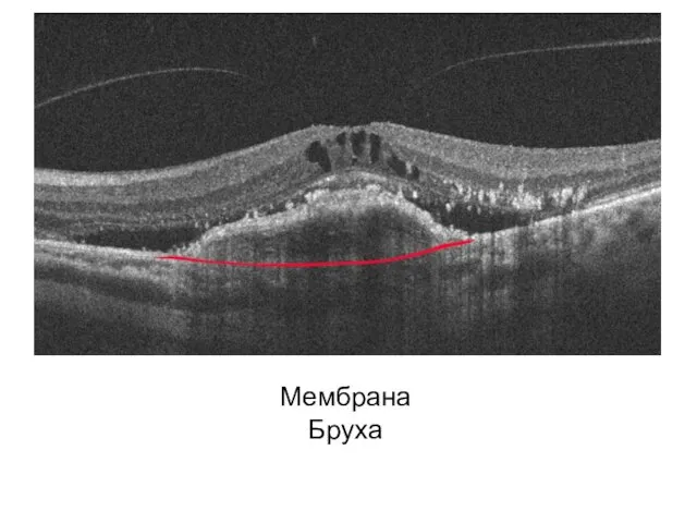 Мембрана Бруха