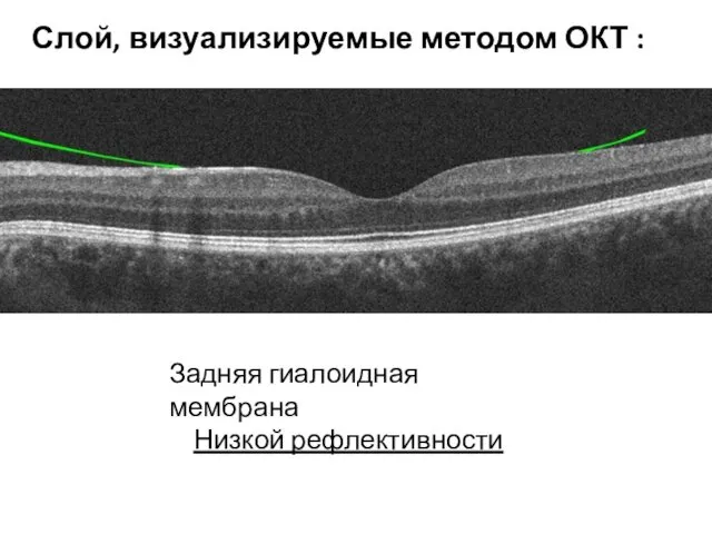 Задняя гиалоидная мембрана Низкой рефлективности Слой, визуализируемые методом ОКТ :
