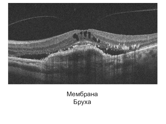 Мембрана Бруха