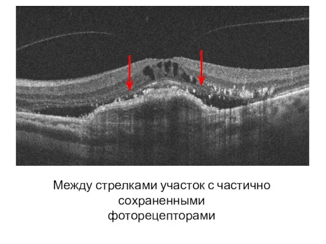 Между стрелками участок с частично сохраненными фоторецепторами