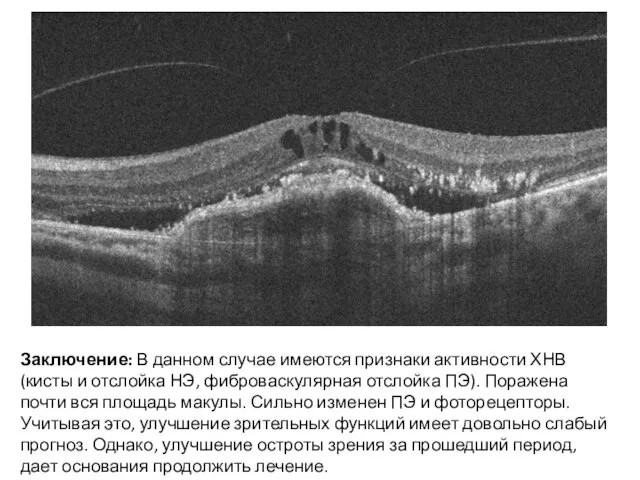 Заключение: В данном случае имеются признаки активности ХНВ (кисты и отслойка