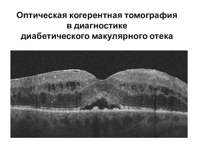 Оптическая когерентная томография в диагностике диабетического макулярного отека