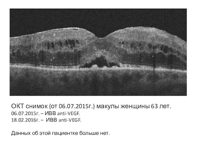 ОКТ снимок (от 06.07.2015г.) макулы женщины 63 лет. 06.07.2015г. – ИВВ