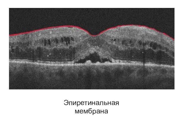 Эпиретинальная мембрана