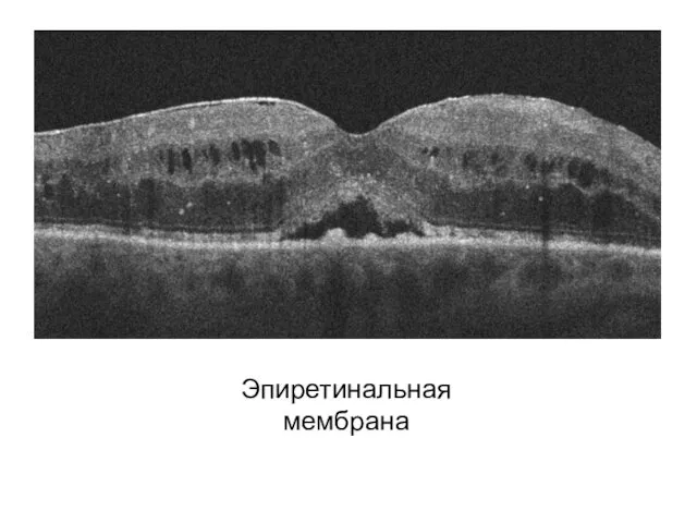 Эпиретинальная мембрана