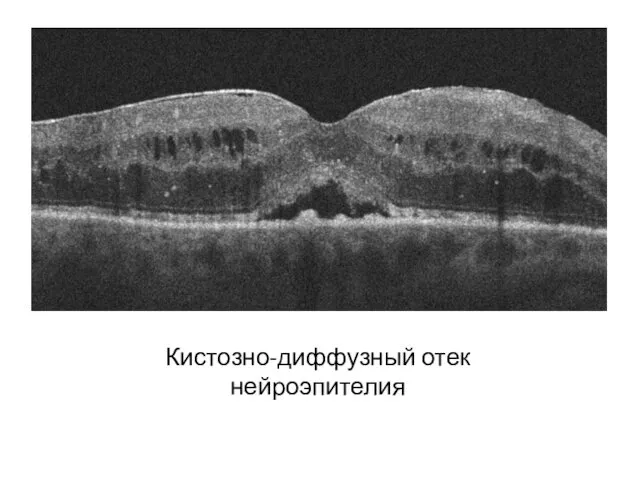 Кистозно-диффузный отек нейроэпителия