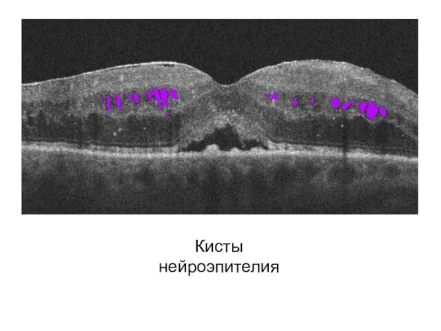 Кисты нейроэпителия