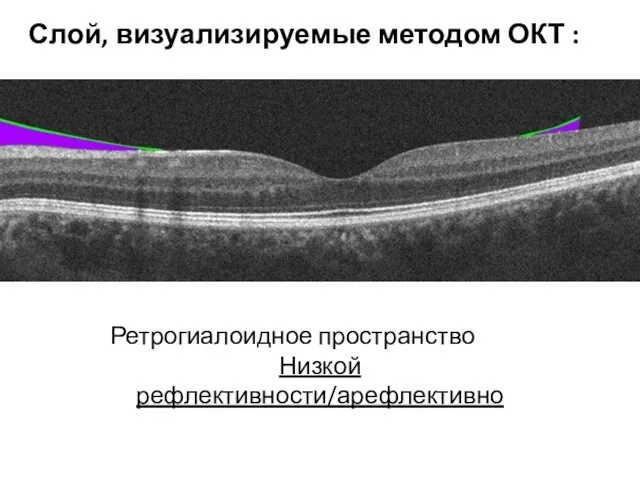Ретрогиалоидное пространство Низкой рефлективности/арефлективно Слой, визуализируемые методом ОКТ :