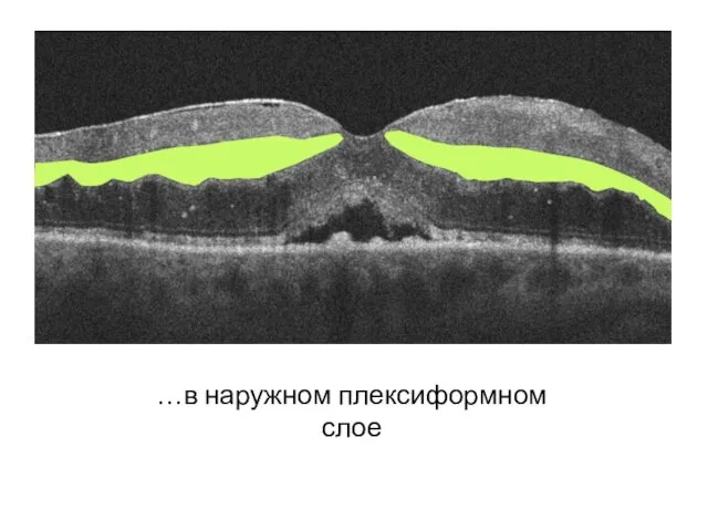 …в наружном плексиформном слое