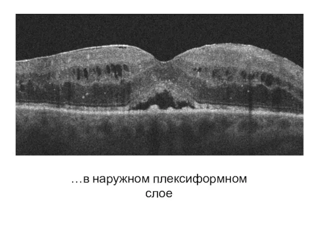 …в наружном плексиформном слое