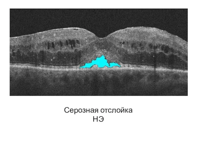 Серозная отслойка НЭ