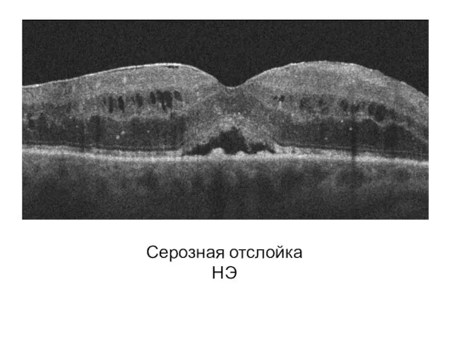 Серозная отслойка НЭ